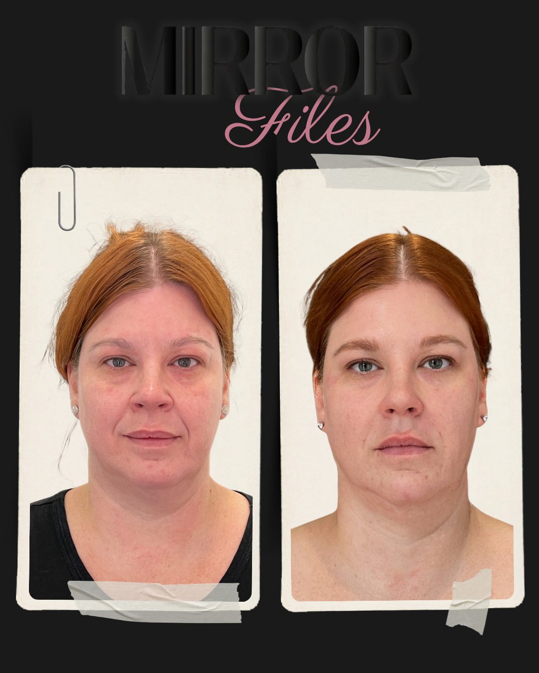 Before and after facial balancing with dermal filler at Mirror by Nurse Yara in Milton, front view