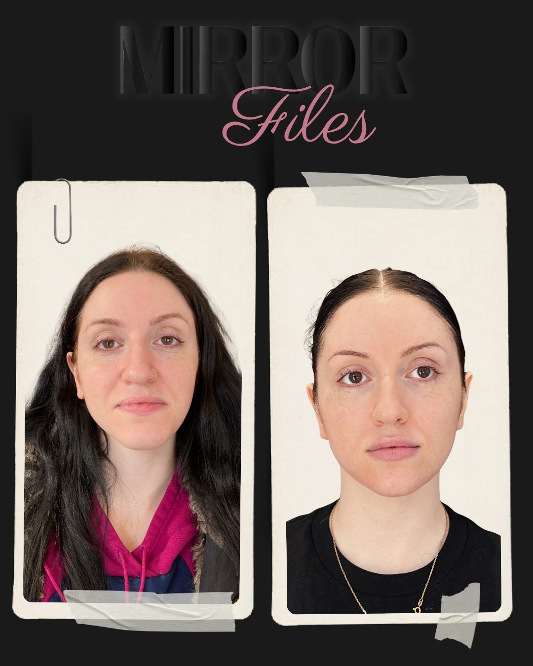Before and after facial balancing with dermal filler on a client in her twenties at Mirror by Nurse Yara, front view