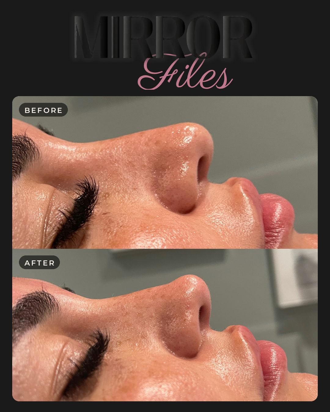 Non surgical rhinoplasty before and after in side profile, Mirror by Nurse Yara, Milton