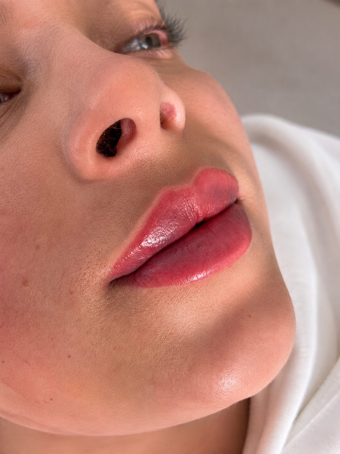 Lip filler result close-up at Mirror by Nurse Yara