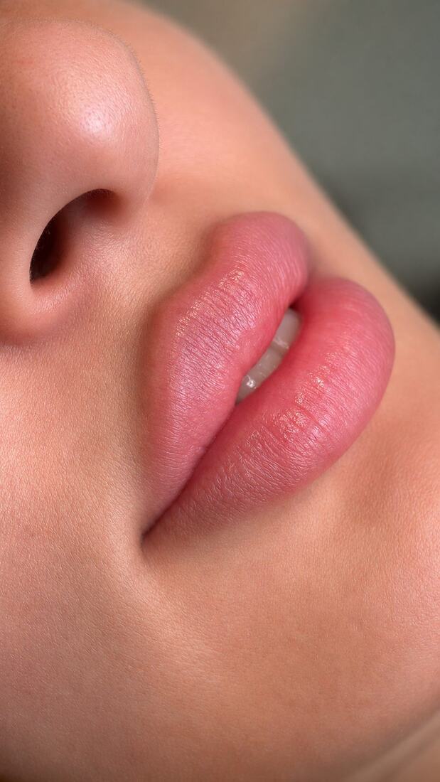 Lip filler before and after by Mirror by Nurse Yara
